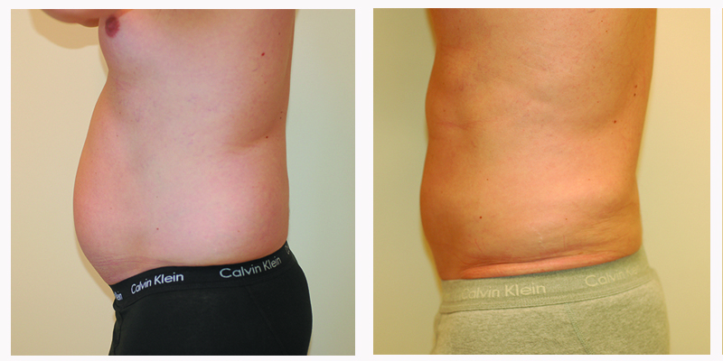 Get Back In Shape With Liposuction
