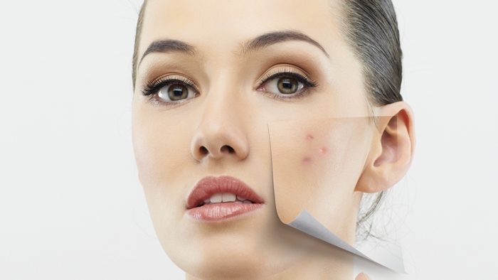 The Causes and Possible Cures Of Adult Acne