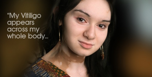 Vitiligo - White Spots, Black Thoughts, Bright Future